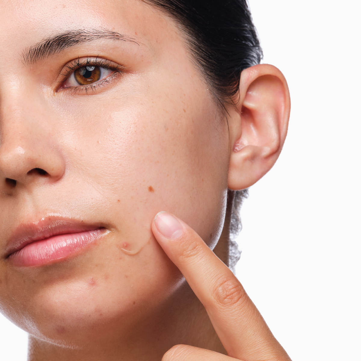 the-acne-set-x6 rdn-the-acne-set-application.png