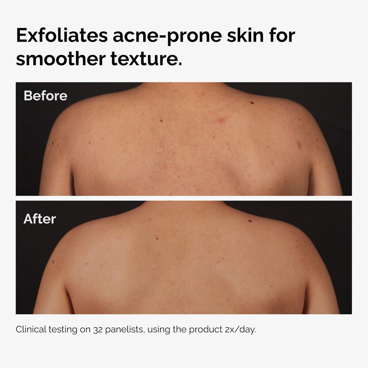 salicylic-acid-0-5-body-serum-y7 ord-salicylic-acid-body-serum-before-after-graphic-NA.jpg