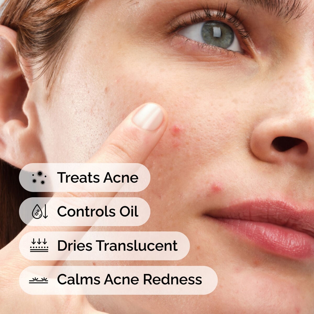 sulfur-10-powder-to-cream-concentrate-m2 ord-sulfur-10pct-powder-to-cream-concentrate-model-application-with-benefits-acne.jpg